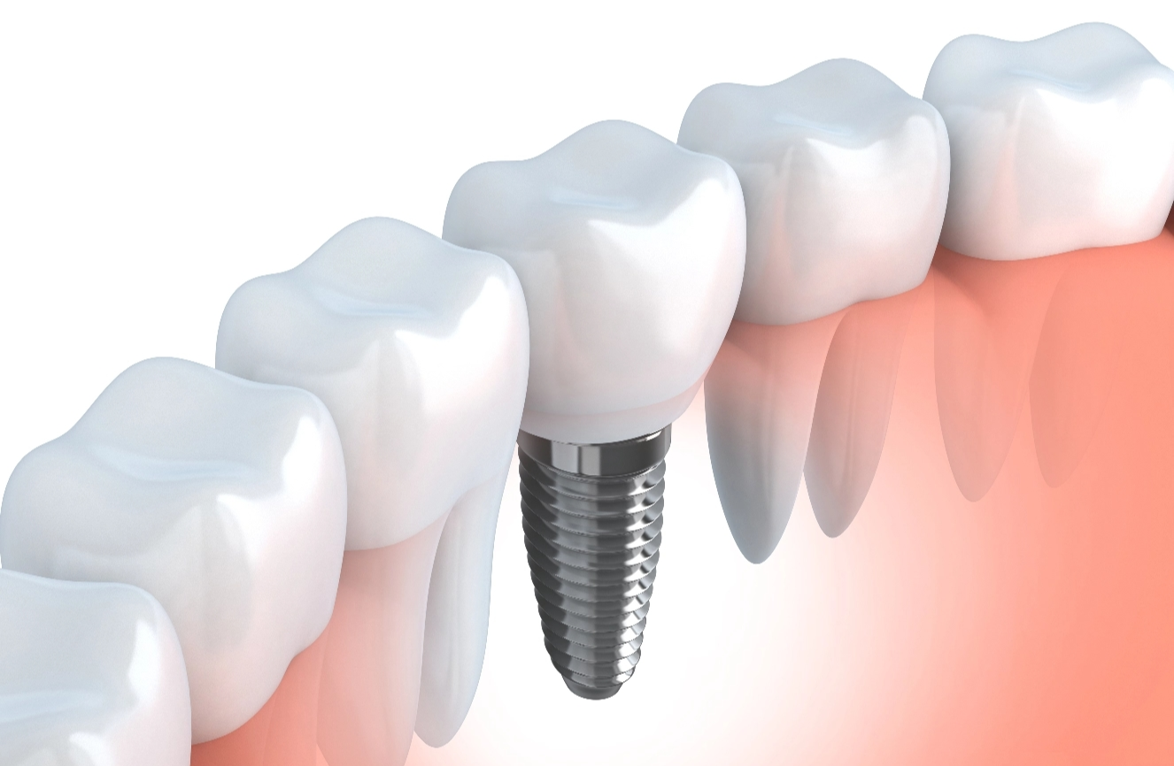 how-dental-implants-work