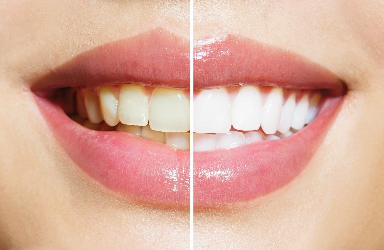 teeth-whitening