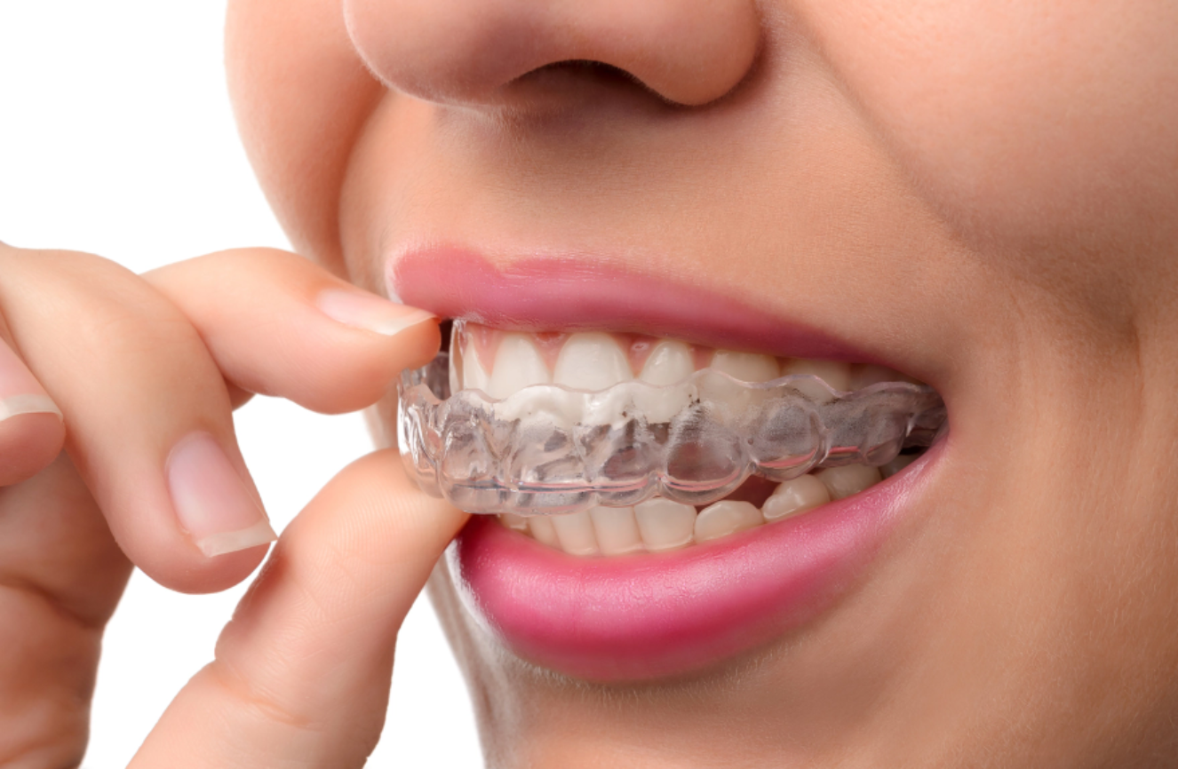 clear-aligners-service